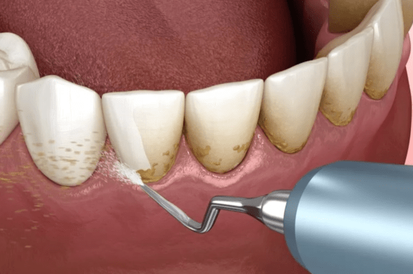 How Can I Do Self Dental Care
