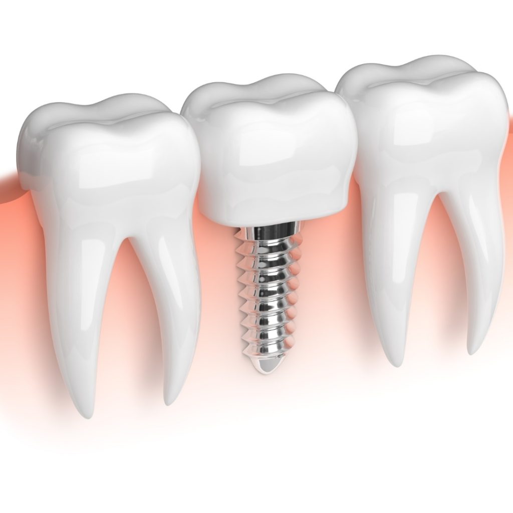 do dental implants look natural