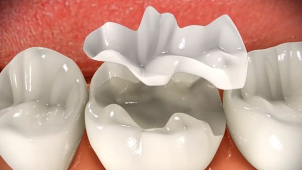 Do Dental Implants Look Natural